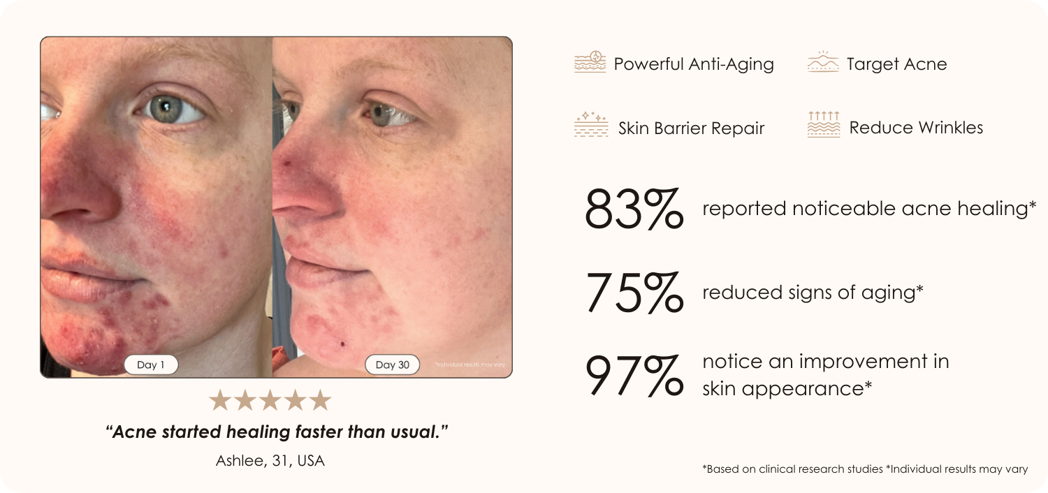 LightAura Plus LED face neck mask light therapy before and after results  showing reduced acne after 30 days