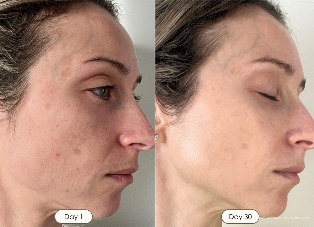 LightAura Plus LED face neck mask light therapy before and after results  showing faded acne scars and reduced redness after 30 days